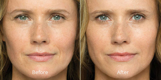 The Magic of Belotero: Achieving Natural-Looking Results at Lee Rose Aesthetics