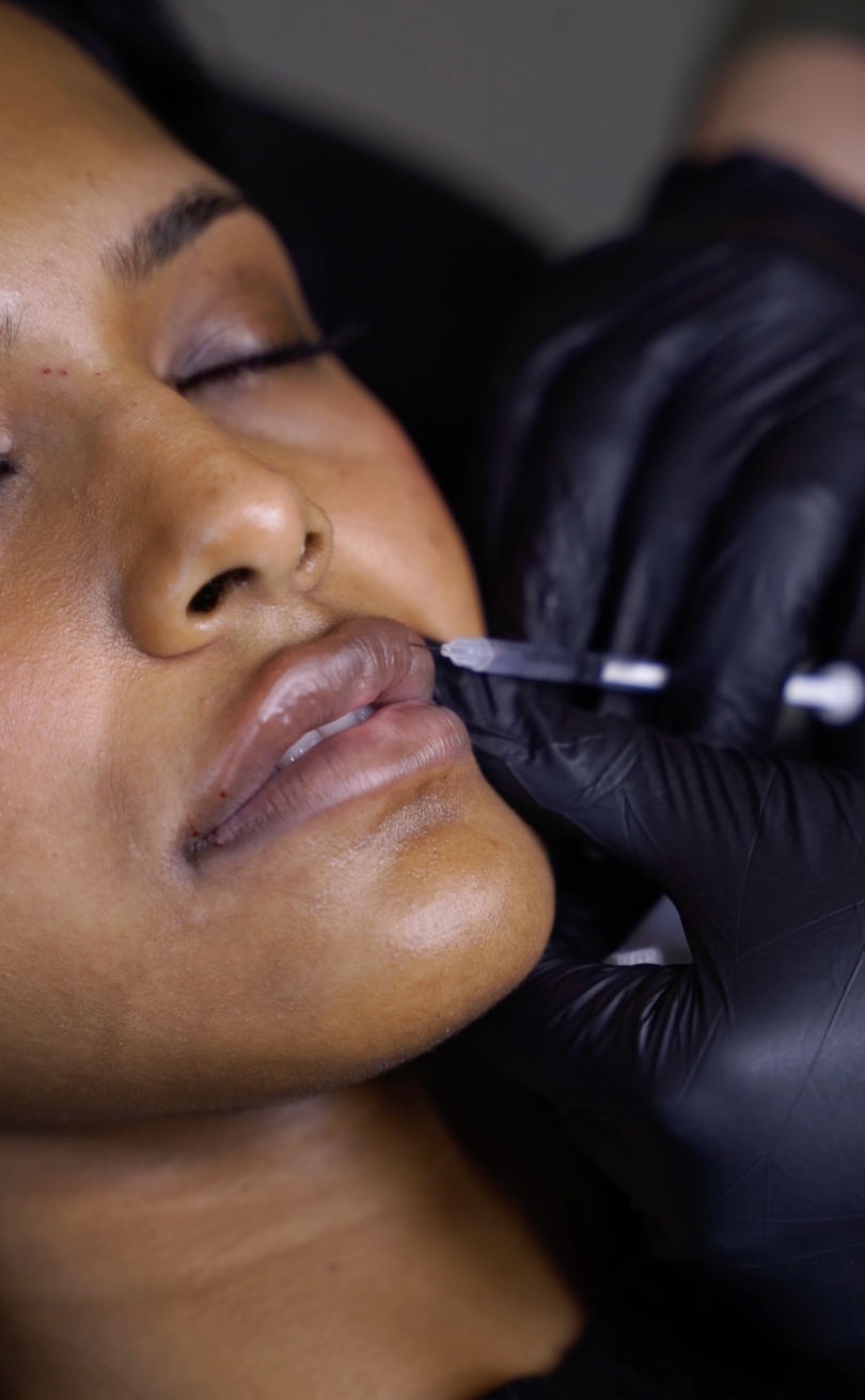 highest rated lip filler in Fort Collins