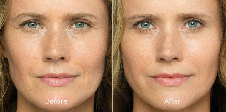The Magic of Belotero: Achieving Natural-Looking Results at Lee Rose Aesthetics