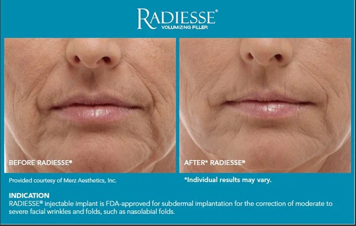 Radiesse: The Collagen-Stimulating Filler You Need to Know About